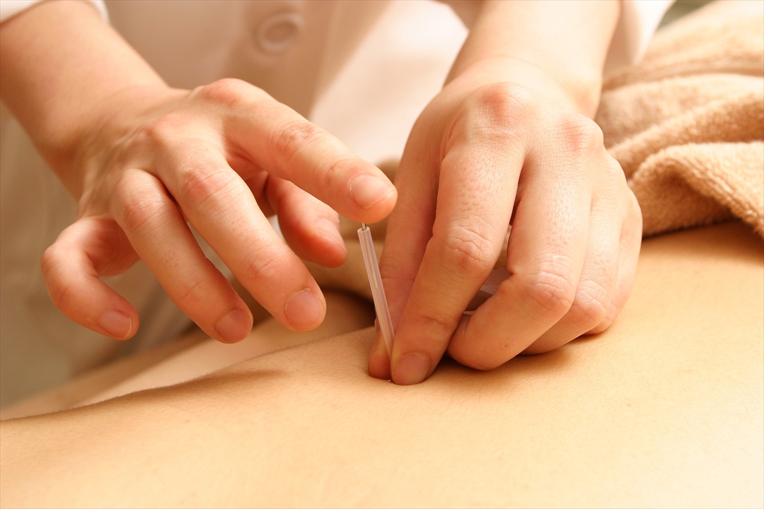針治療